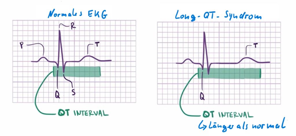 Long-QT-Syndrom